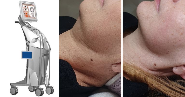 Duet RF THERMAGE rádiófrekvenciás kezelés-Rubos Vivien